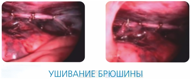 ушивание брюшины